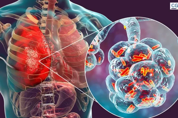 Legionnaires' disease
