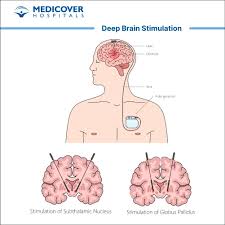 Brain Stimulation Technique May Give More Relief from Parkinson’s Symptoms 2024 WONDERFUL