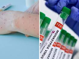 monkeypox virus