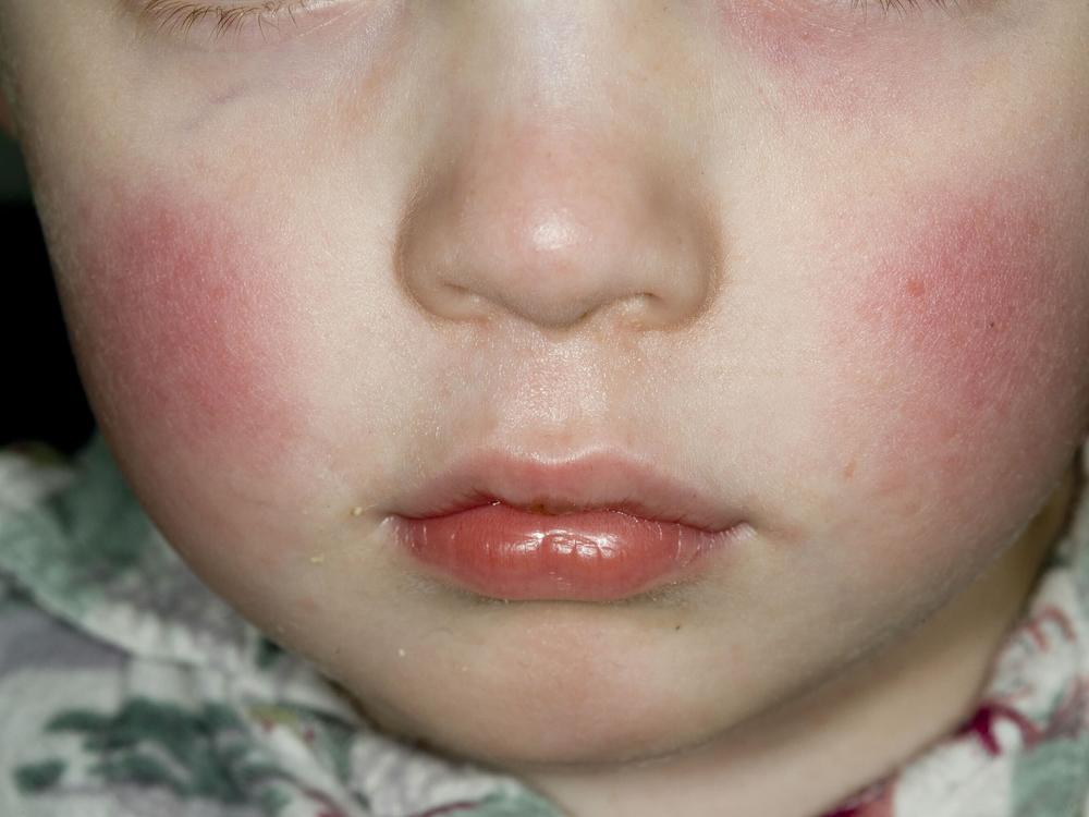 What to know about the ‘slapped cheek’ virus uptick in the U.S. 2024 wonderful